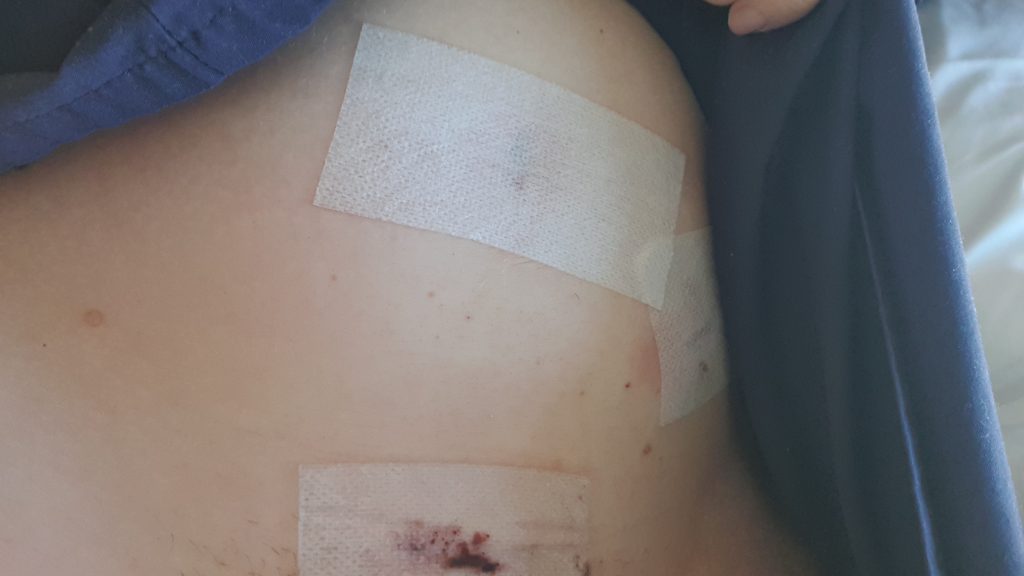 surgical incisions